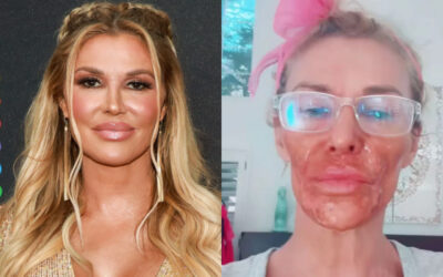 OMFG: Brandi Glanville Ends Up With Severe Chemical Burns After Attempting To Remove Facial Parasite With Nair