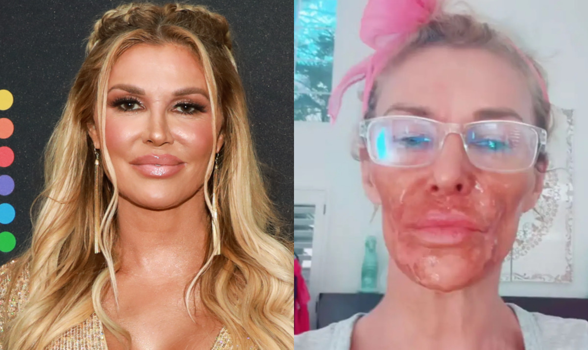 OMFG: Brandi Glanville Ends Up With Severe Chemical Burns After Attempting To Remove Facial Parasite With Nair